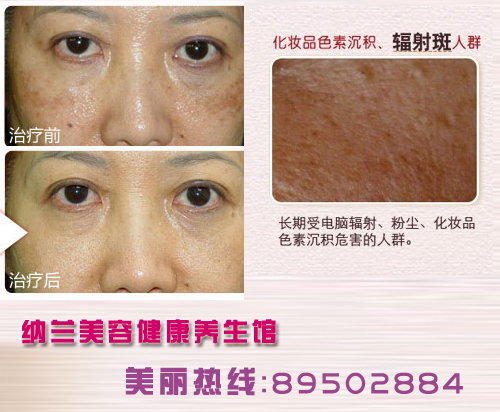 我最近脸上起了好多辐射斑,怎么办霜好用吗?急